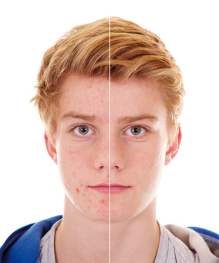 Teenager mit unreiner Haut | vorher – nachher Teenager mit unreiner Haut | vorher – nachher